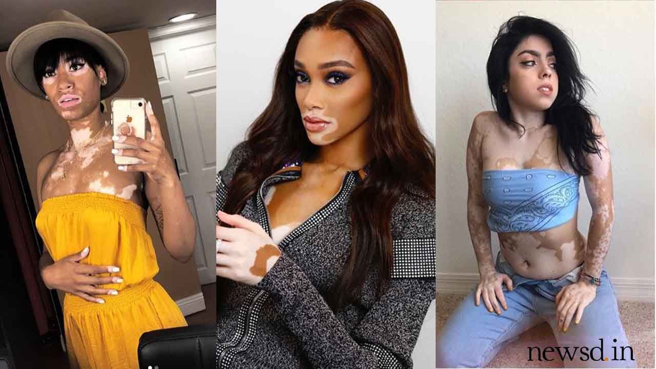 Breaking Stereotypes: Models with ‘Vitiligo’ who redefined beauty in the rigid modeling industry