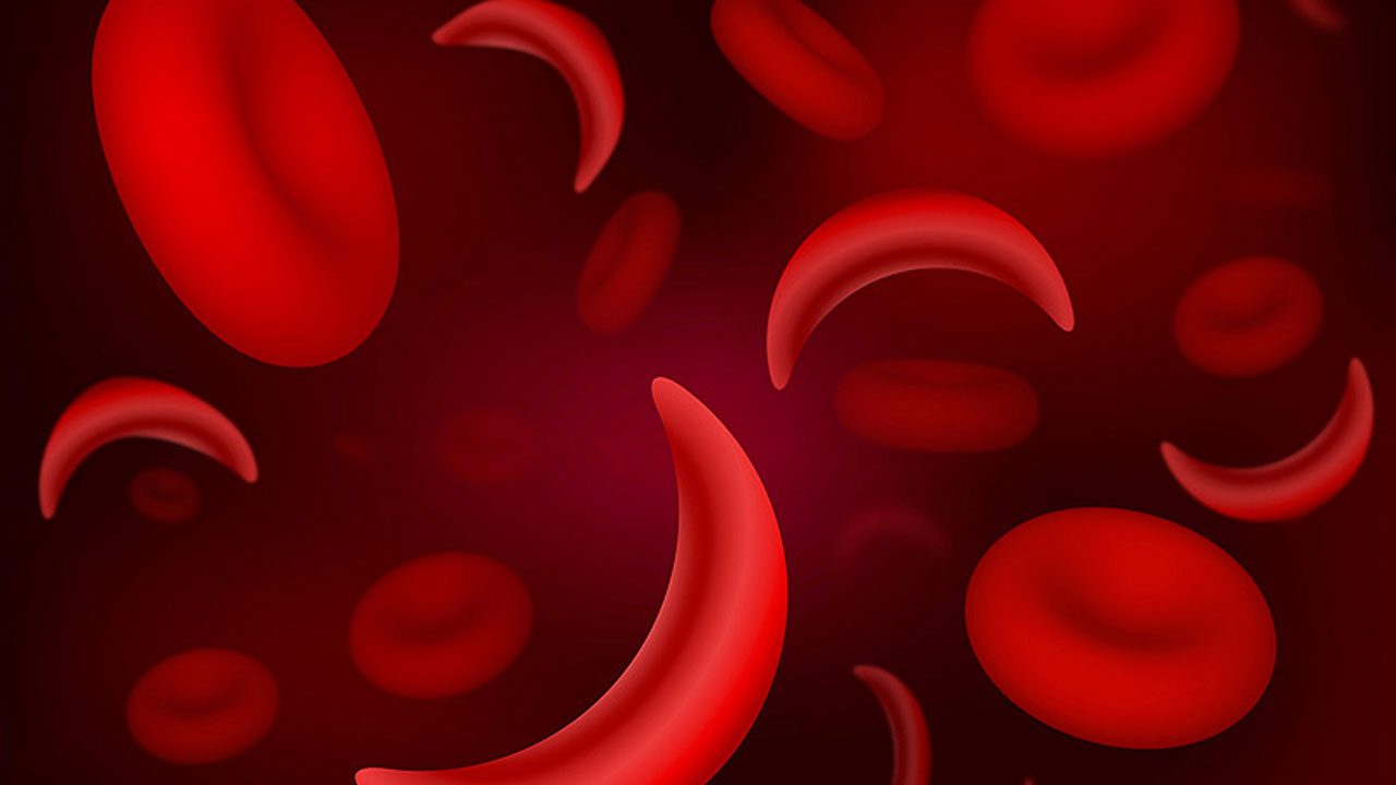 World Sickle Cell Day 2019: Theme, significance of the day for raising awareness about genetic disease