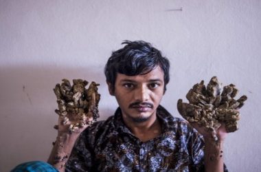 Bangladeshi ‘Tree Man’ wants arms amputated to relieve pain caused by a rare syndrome