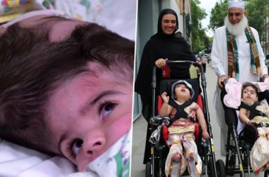 Conjoined twins from Pakistan separated after 55-hour-long surgery in London