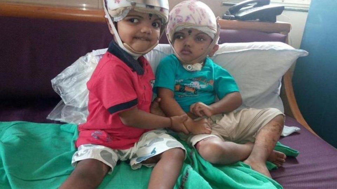 Surgically separated Odisha conjoined twins leave for home