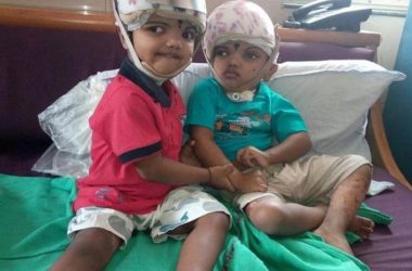 Surgically separated Odisha conjoined twins leave for home