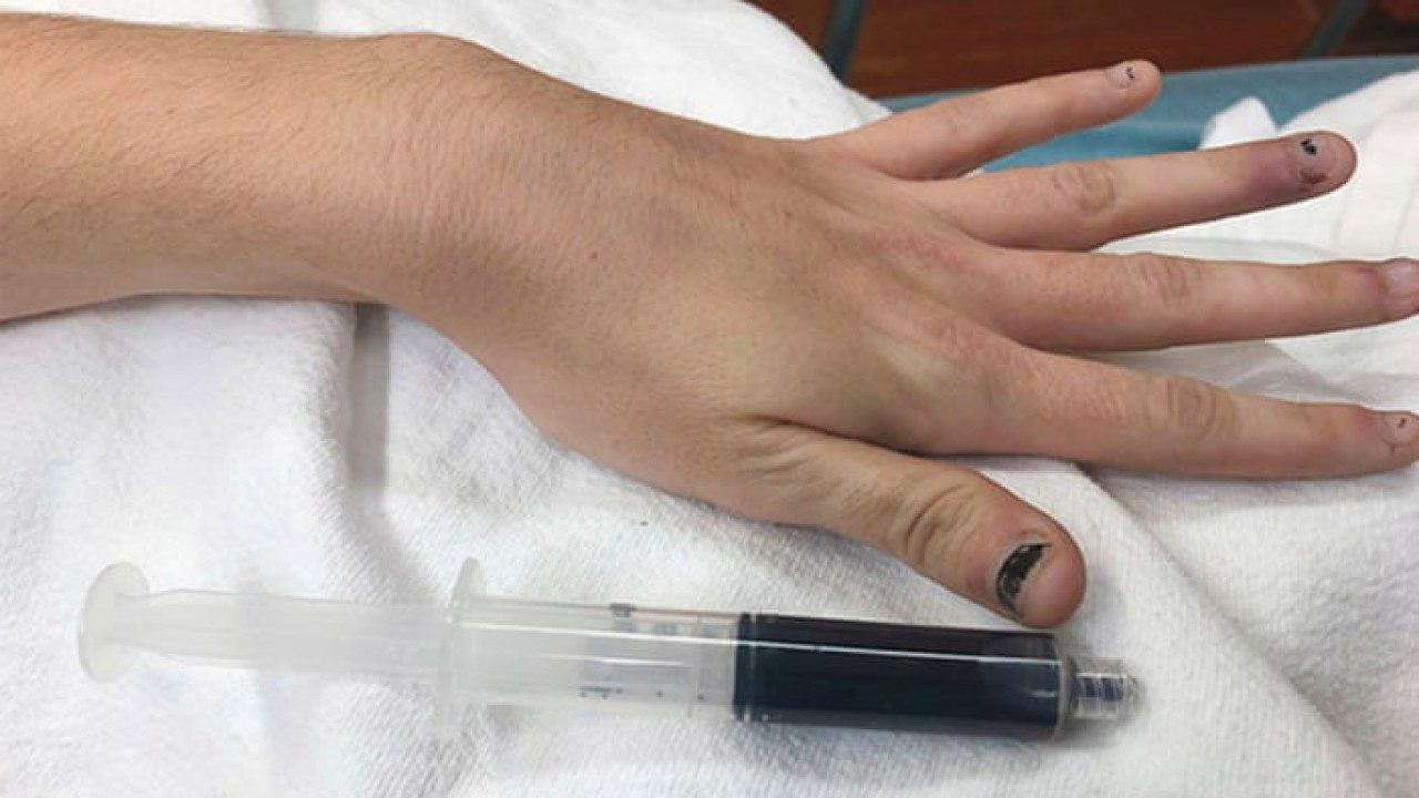 Rhode Island Woman’s blood literally turns blue, Here’s how it happened