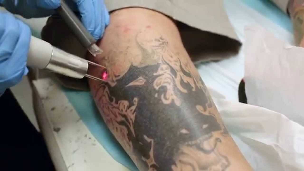 6 ways to remove a Tattoo