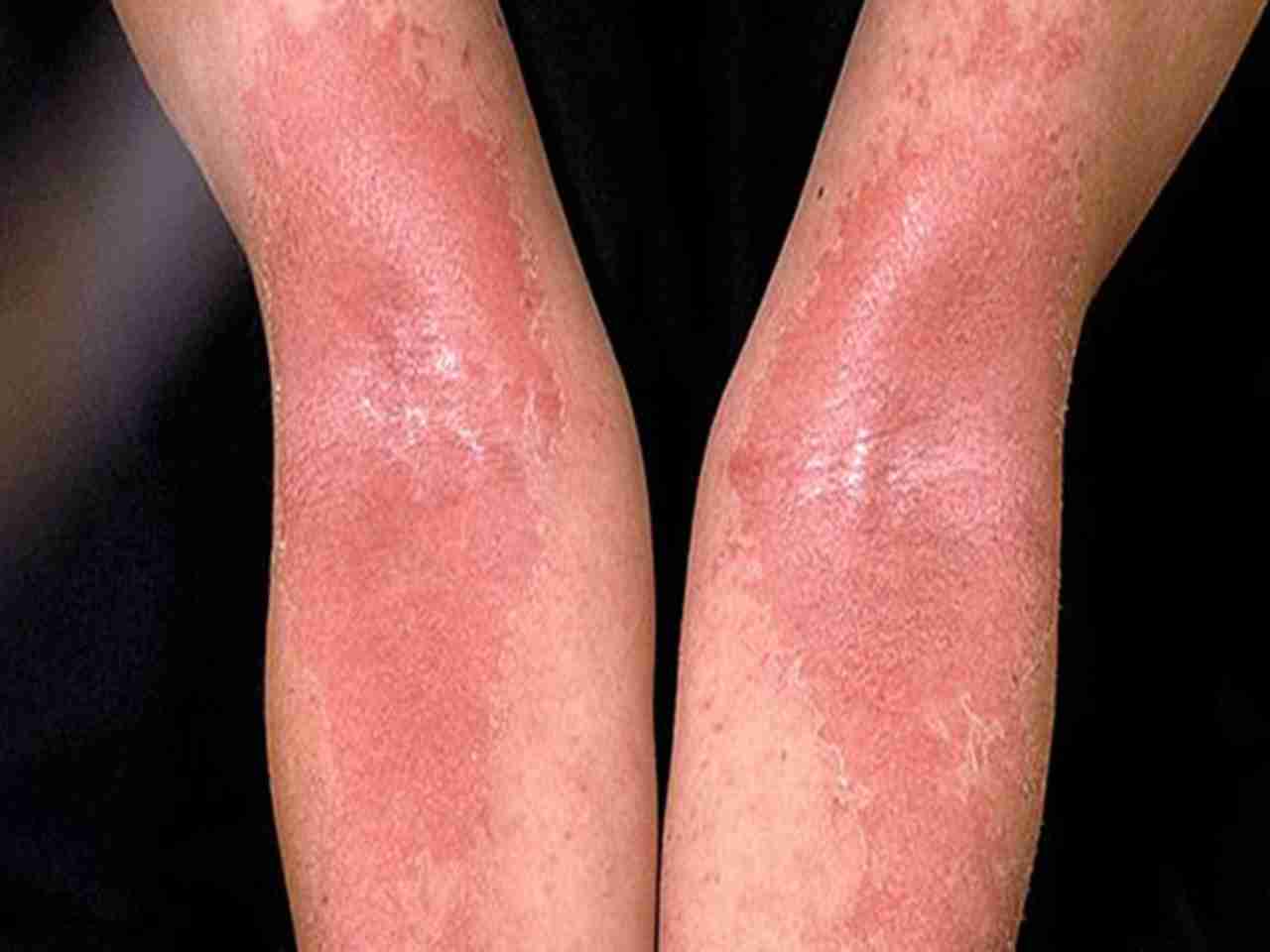 Scientists discover new drug to lower symptoms of severe eczema
