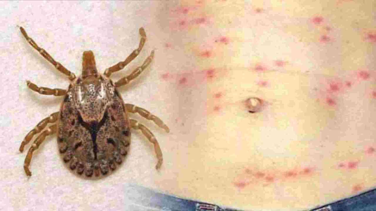 29 cases of mite-borne rickettsiosis ‘scrub typhus’ in Mathura, alert sounded