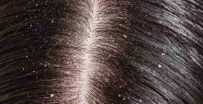 This winter, drive away your dandruff with these 10 smart tricks