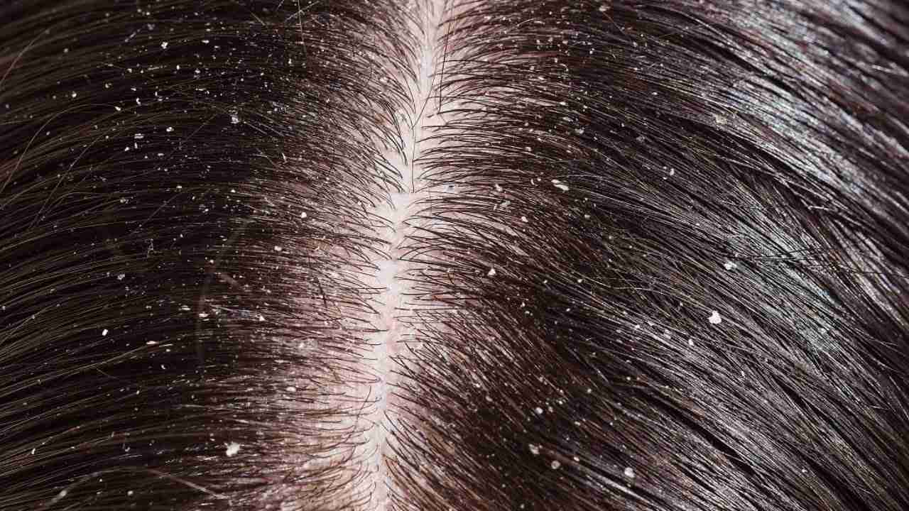 This winter, drive away your dandruff with these 10 smart tricks