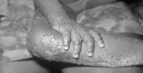 How does monkeypox spread from person to person?