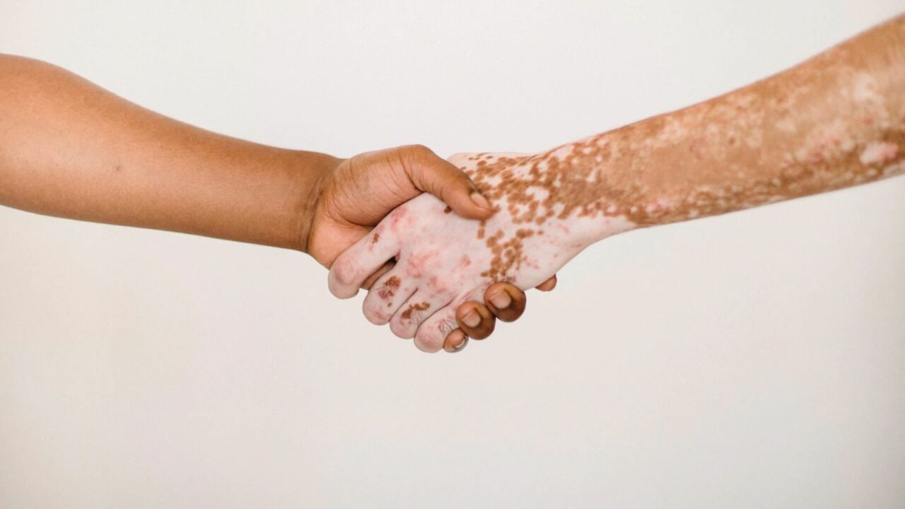 World Vitiligo Day 2022: How to detect Vitiligo and signs people should look out for