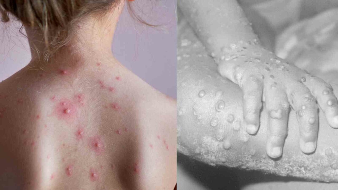 Monkeypox vs Chickenpox: Difference in way symptoms on both diseases manifest in patients, say docs