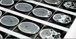 New injectable gel holds promise for tough-to-treat brain tumours