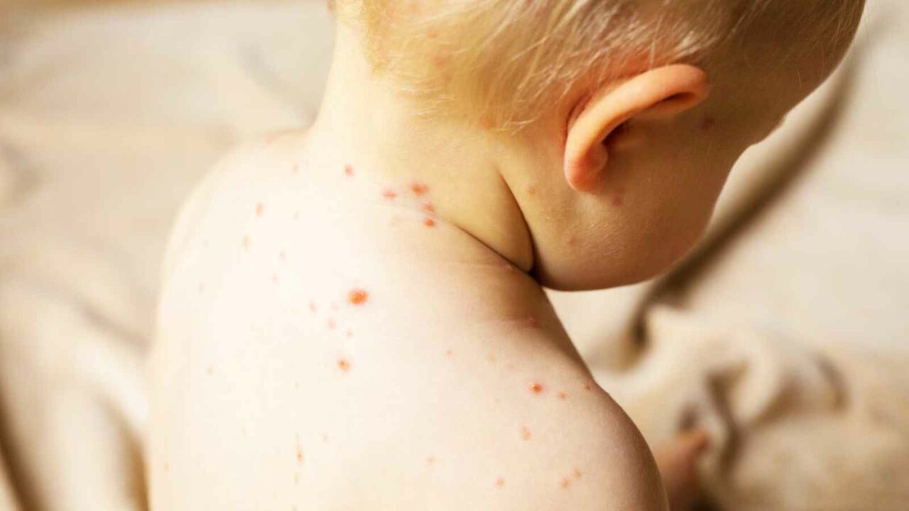 7 suspected measles deaths, 164 cases reported in Mumbai since September: Civic body