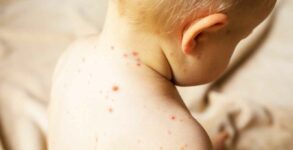 7 suspected measles deaths, 164 cases reported in Mumbai since September: Civic body