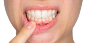 Researchers find gum infection may be a risk factor for heart arrhythmia