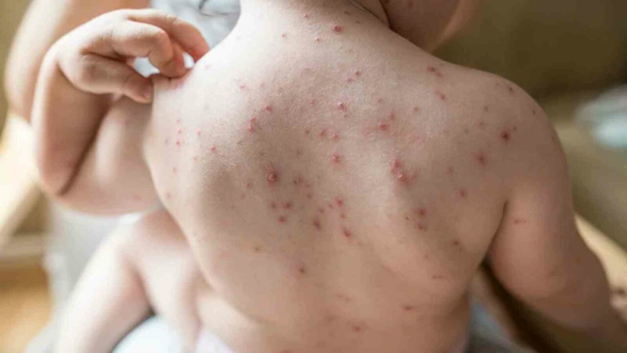 Nine students of UP govt primary school infected with chickenpox
