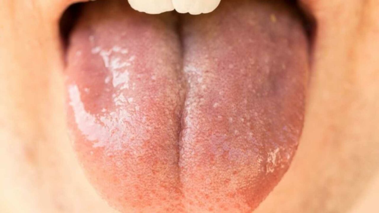 5 Natural Ways to Soothe Your Burnt Tongue: Easy home remedies