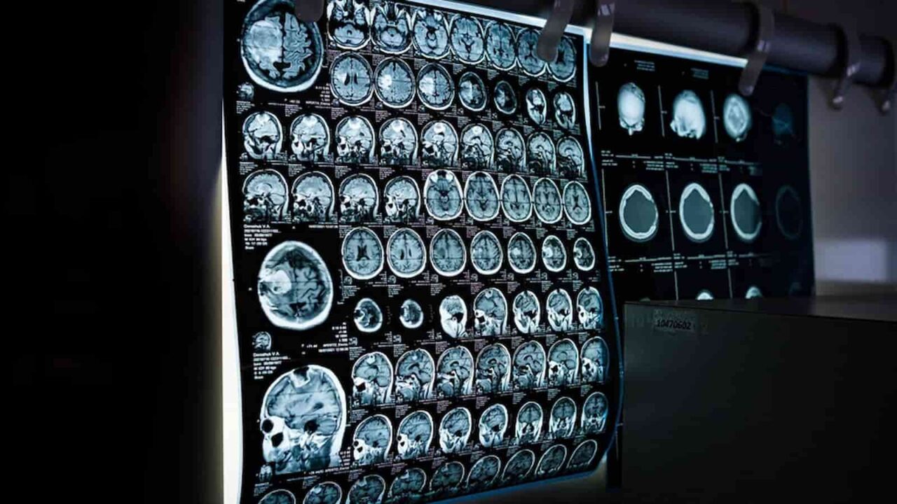 AI-model developed that could tell age from chest X-ray