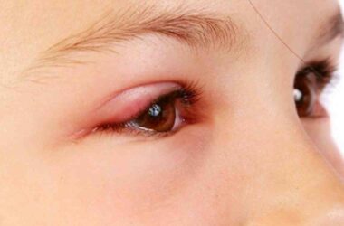 Protecting Your Eyes: Understanding Conjunctivitis and Preventive Measures During Seasonal Outbreak
