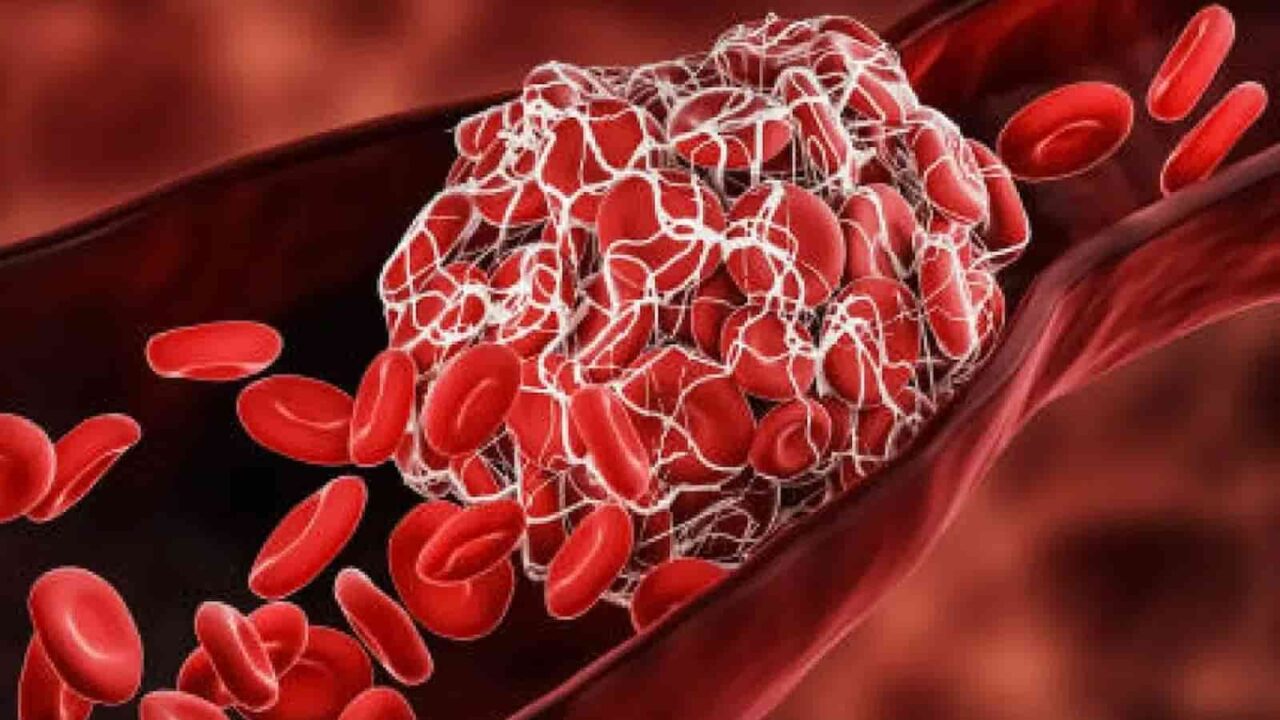 World Thrombosis Day 2023 FAQs, Activities, History, Dates, Facts About Thromboxosis