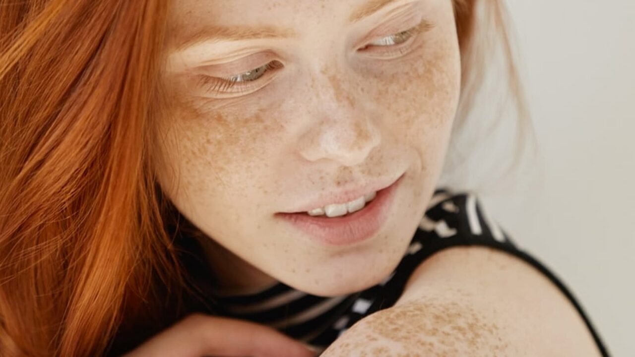 Love Your Freckles Day 2023 Activities, History, Dates, FAQs, and Facts About freckles
