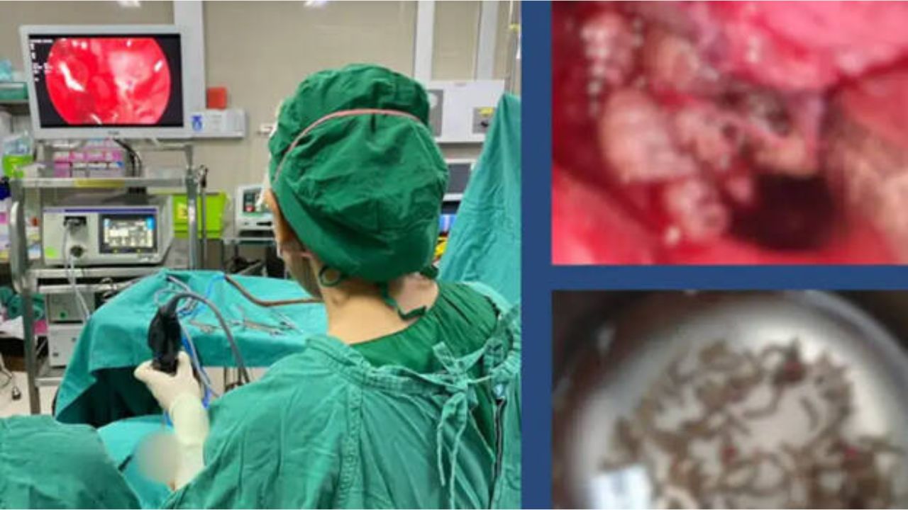 Woman Finds Hundreds of Maggots Inside Blocked Nose
