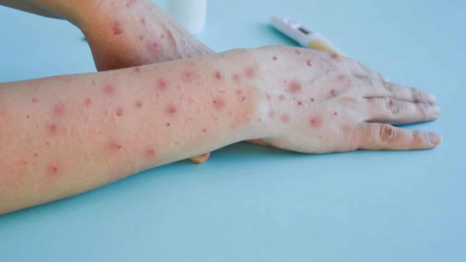 Kerala Reports Another Mpox Case, Urges Vigilance