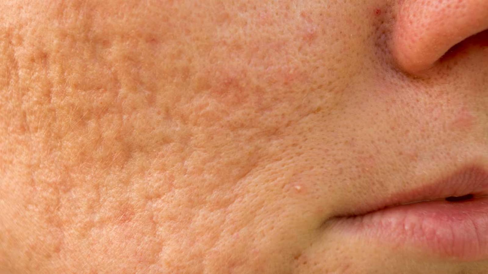 What Products for Acne Scars are Scientifically Proven to Show Results?