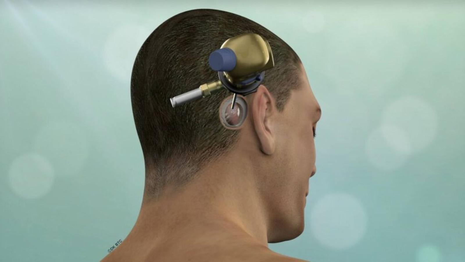 Kilpauk Keyhole Craniotomy: Chennai Doctors Introduce Safer Brain Haemorrhage Surgery