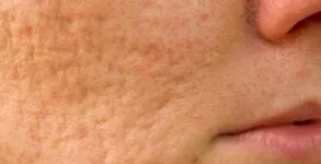 What Products for Acne Scars are Scientifically Proven to Show Results?